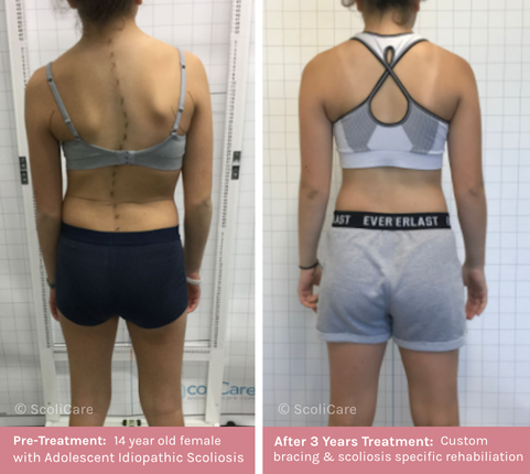 AIS (1) Adolescent Idiopathic Scoliosis