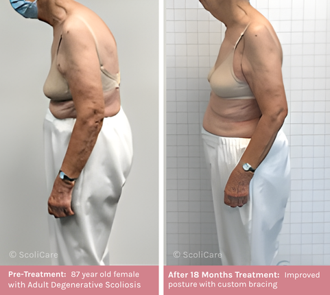 Adult (1) Adult Scoliosis