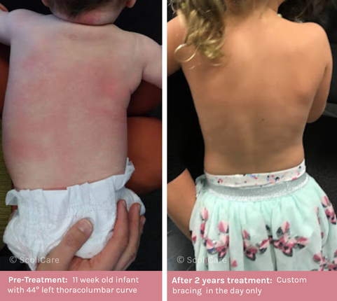 Infantile (1) Infantile Scoliosis