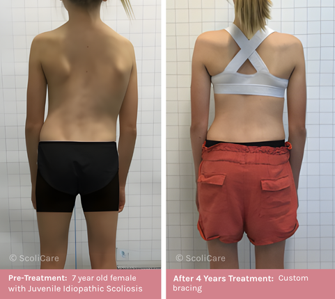 Juvenile (1) Juvenile Scoliosis